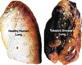 A healthy human lung and a lung damaged by smoking.