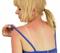 A girl pulling her tank top strap back to reveal a bad sunburn.